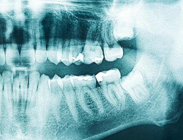 All digital dental x-rays