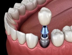 Animated smiling during dental implant supported dental crown placement
