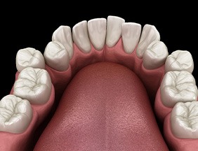 Illustration of crooked teeth