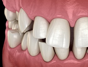 Illustration of gapped teeth