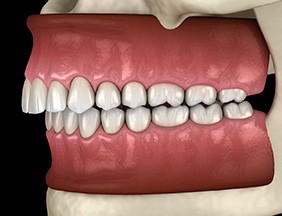 Illustration of an overbite