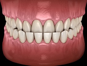 Illustration of an underbite