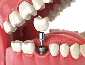 3D illustration of dental implant