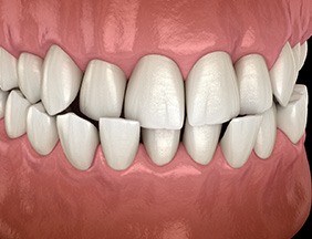 Illustration of a crossbite