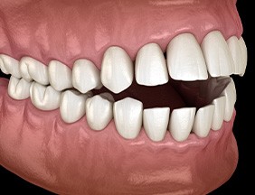 Illustration of an open bite