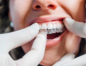 Closeup of gloved hands placing Invisalign over patient’s upper arch