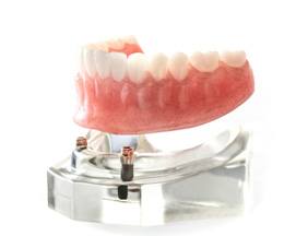 model of an implant denture