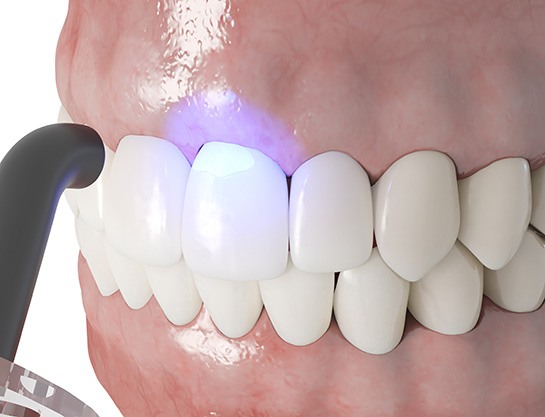 Close up of cosmetic bonding