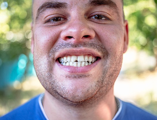 Close up of a chipped tooth