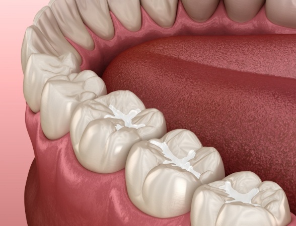 Animated smile after tooth colored filling restorative dentistry