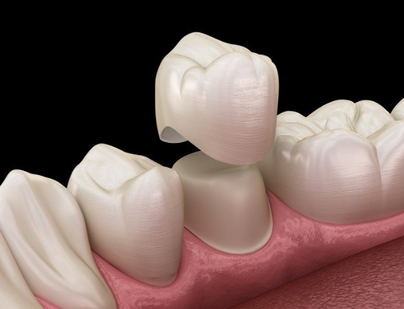 Animated smile during dental crown placement