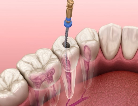 Animated smile during root canal therapy