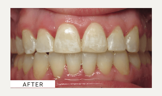 Invisalign after