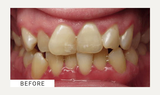 Invisalign before