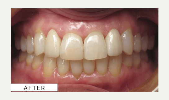 Invisalign after
