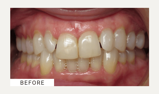 Invisalign before