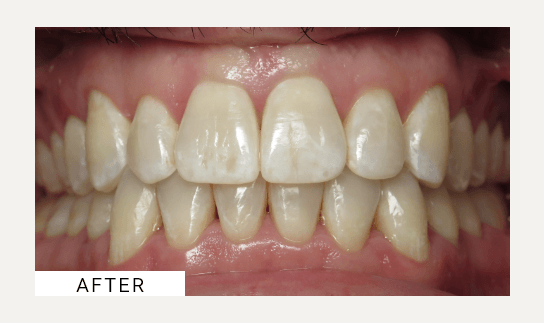 Invisalign after