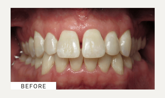 Invisalign before