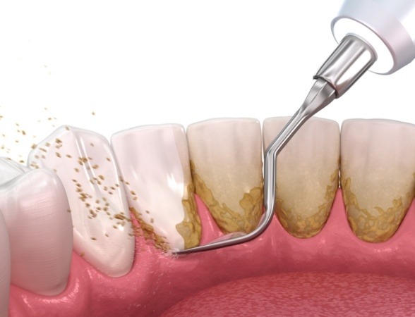 Animated smile during scaling and root planing periodontal therapy