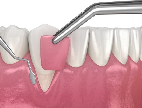 Animated smile during gum grafting treatment