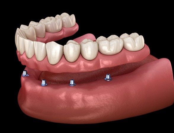Illustration of implant dentures in Carrollton, TX for the lower arch