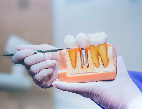 Dentist pointing to a dental implant