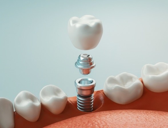 Animated smile during tooth replacement with dental implants