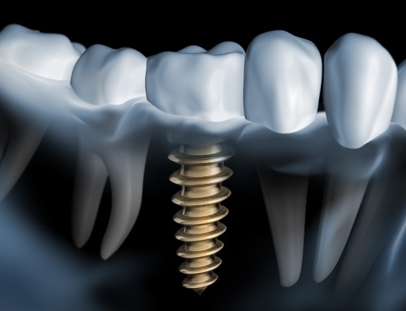Animated smile after four step dental implant process