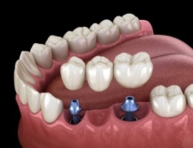 Animated smile during dental implant supported fixed bridge placement