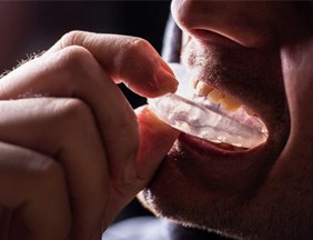 a man wearing custom mouthguards to protect dental implants 