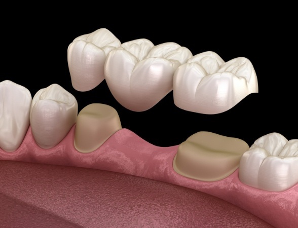 Animated smile during dental bridge placement