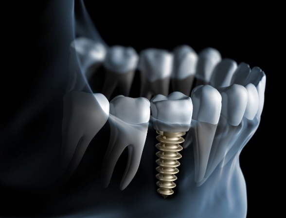 Animated smile after tooth replacement with dental implants