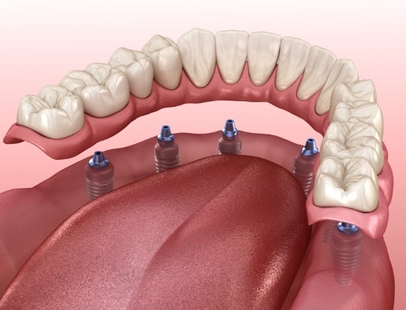 Animated smile during full mouth reconstruction