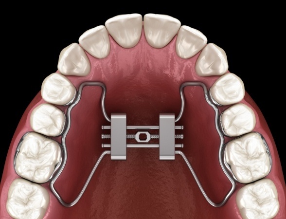 Animated smile with palatal expander