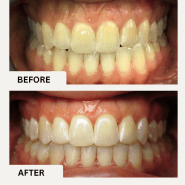 Before and after photos showcasing teeth whitening results at Anthony Dillard, DDS Family & Cosmetic Dentistry.
