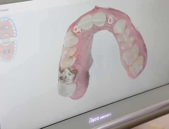 iTero digital bite impressions on chairside computer