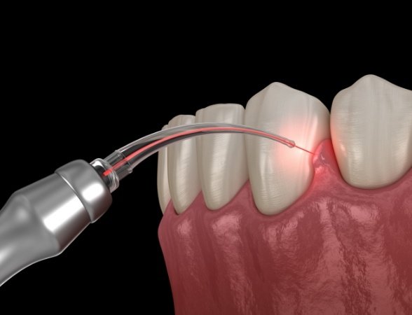 Animated smile during soft tissue laser dentistry