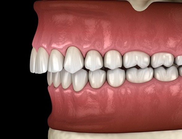 Animated smile in need of occlusal adjustments