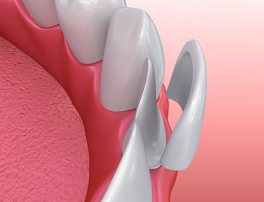 Illustration of veneer in Carrollton being placed on tooth