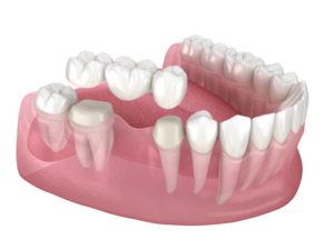 dental bridge 3D illustration 