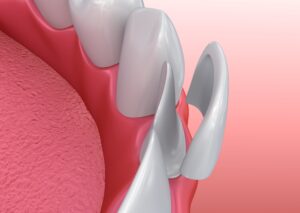 Model of a veneer next to a prepped tooth